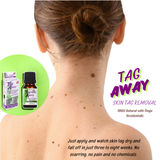 Nature's Pillows Tag Away Skin Removal - Natural Wart & Skin Tag Treatment